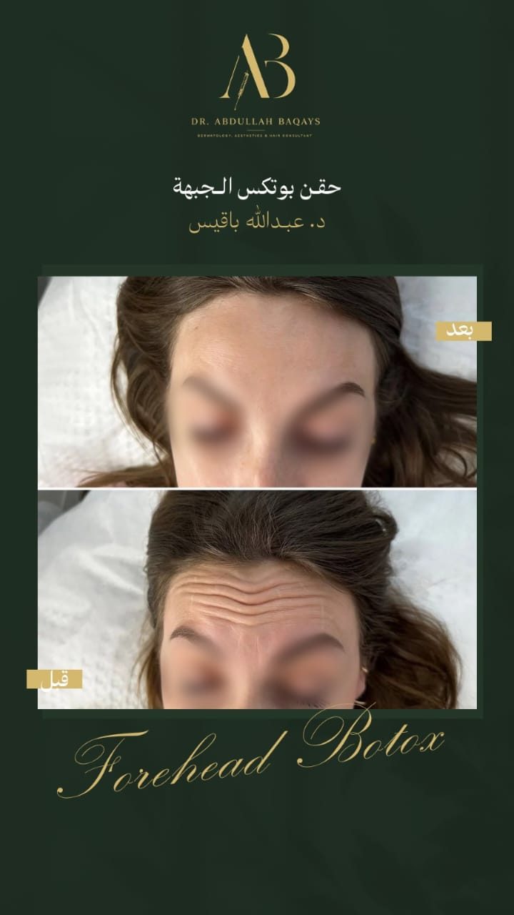 نتيجة حقن بوتكس الجبهة قبل وبعد — د. عبدالله باقيس | Forehead Botox before and after