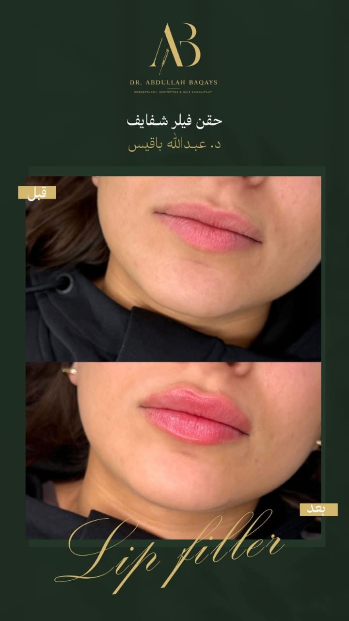 نتيجة حقن فيلر شفايف قبل وبعد — حالة 5 — د. عبدالله باقيس | Lip Filler results