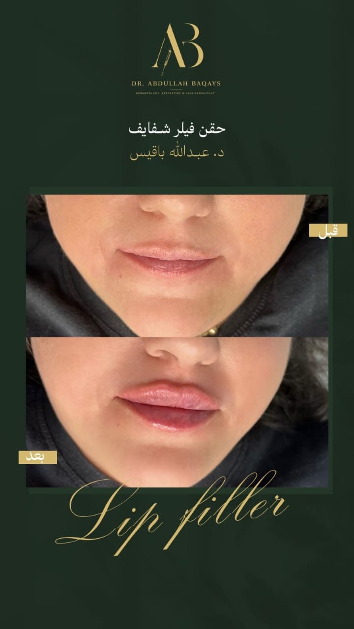 نتيجة حقن فيلر شفايف — حالة 9 — د. عبدالله باقيس